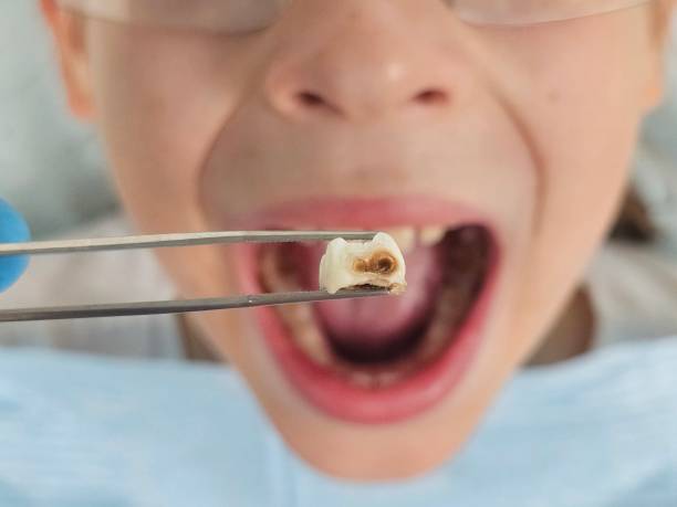Best Emergency Wisdom Teeth Removal in Obetz, OH